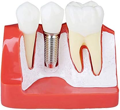 Демонстрационен модел на зъбите с Зубным имплантат KH66ZKY Модел на зъби - Анализ на импланти Демонстрационен Модел на зъбите