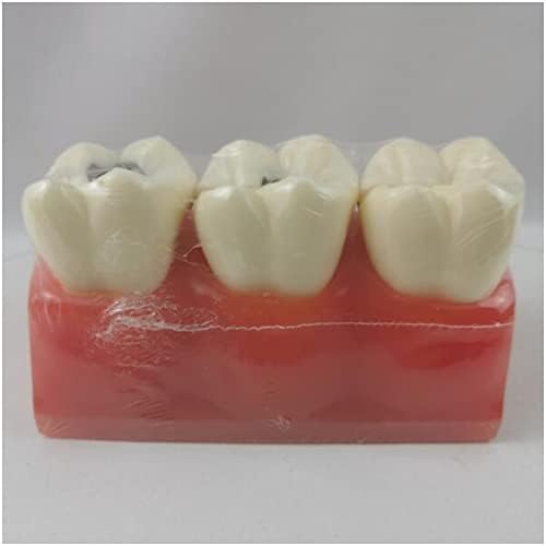 Модел Кариесных зъбите KH66ZKY - Модел Патологични зъби - Модел на Сравнителни изследвания на зъбите с 6-Кратно за унищожаване на Обучителни инструменти за зъболекар и